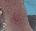 Bite marks on victim's arm